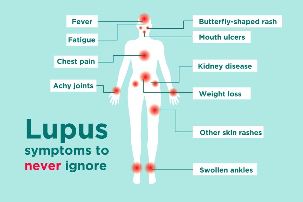0219_Lupus-Symptoms