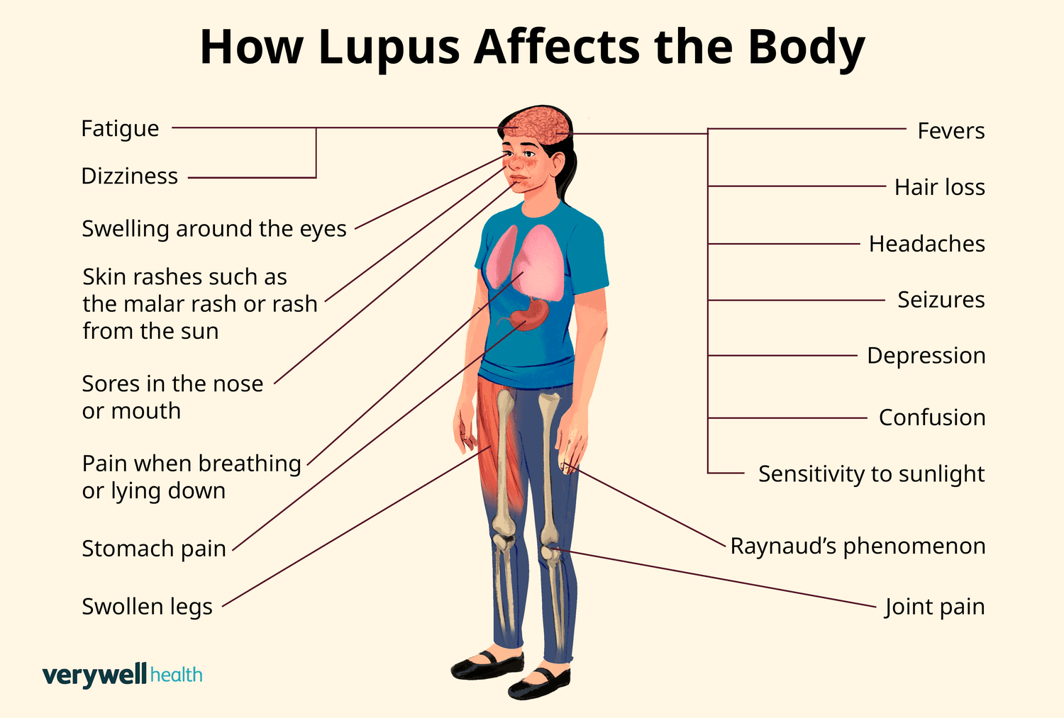 VWHNewCreate-Lupus-e80d89d3b3ff4b38b798f9e84468f04c