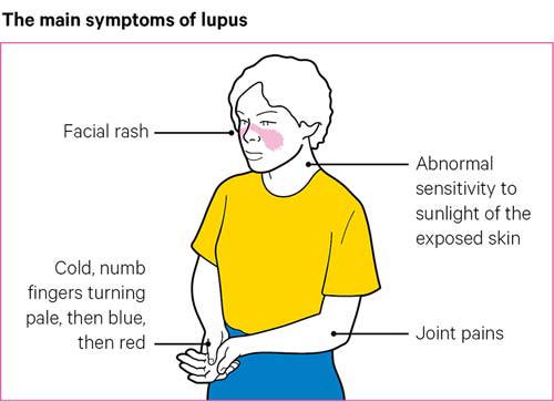 lupus-symptoms-500×363