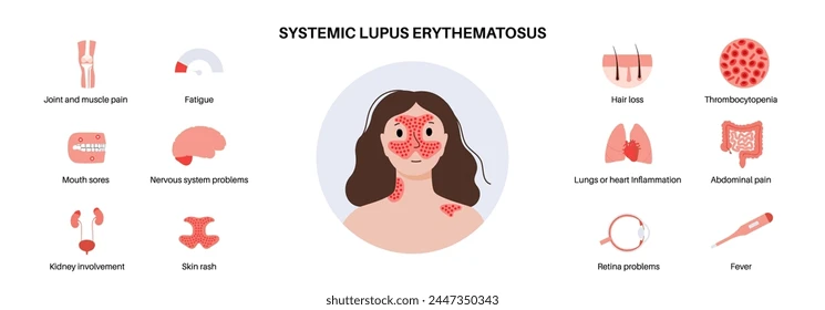 systemic-lupus-erythematosus-medical-poster-260nw-2447350343