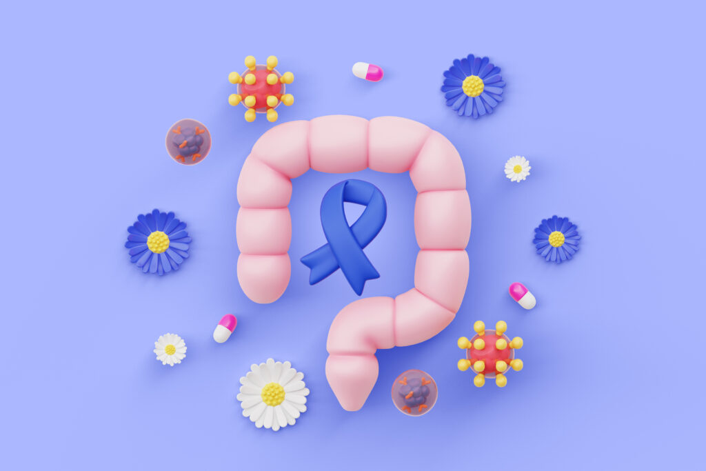 Ulcerative Colitis
