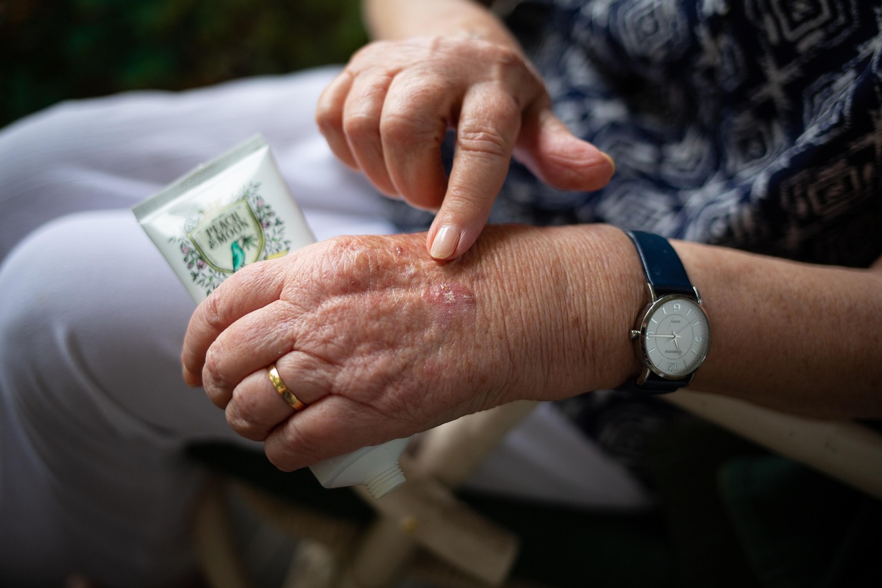 Arthritis