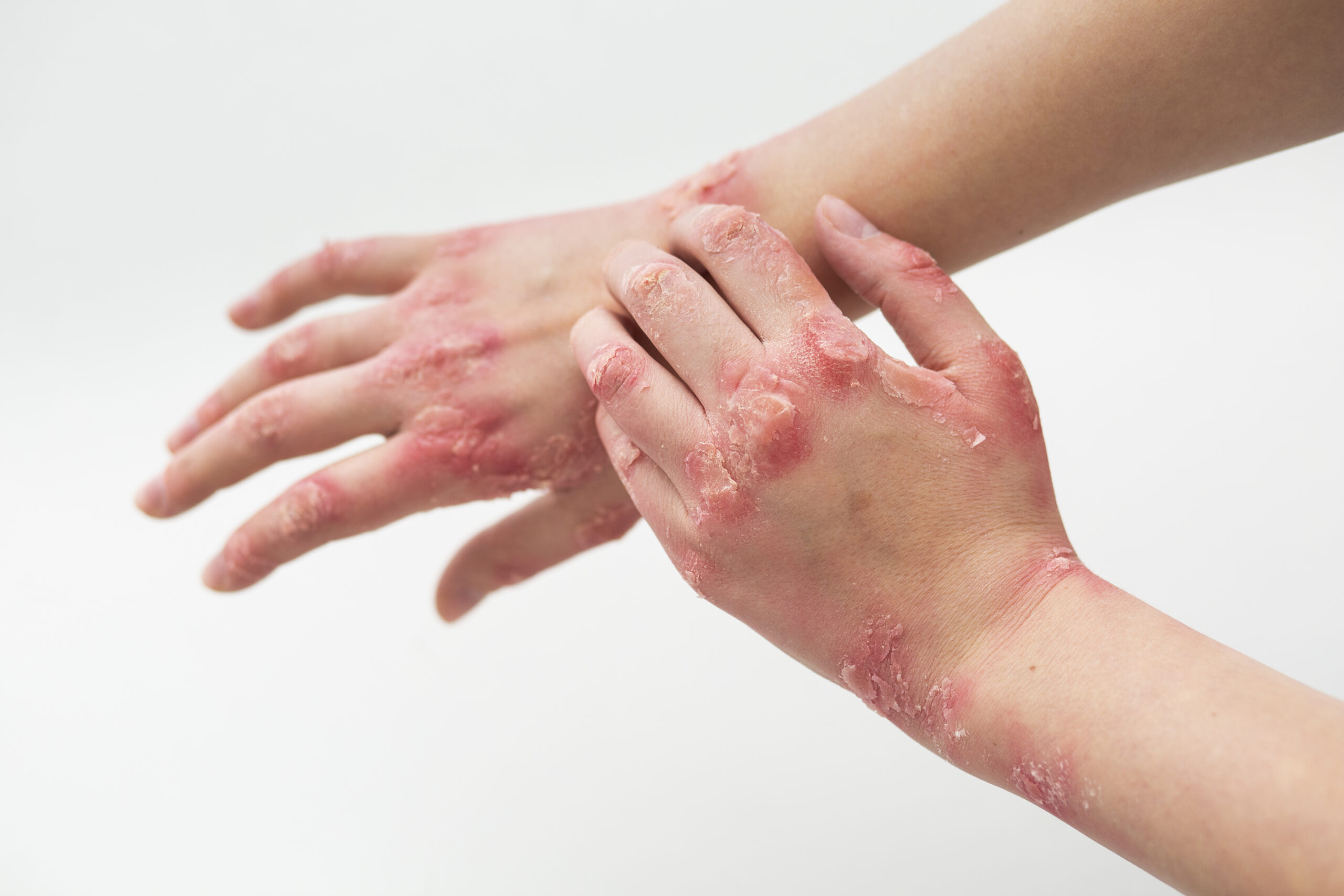 Eczema