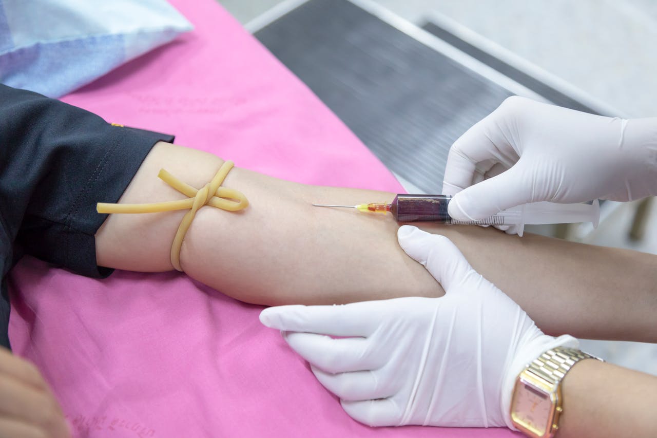 DVT (Deep Vein Thrombosis)