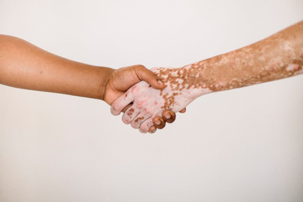 Psoriasis