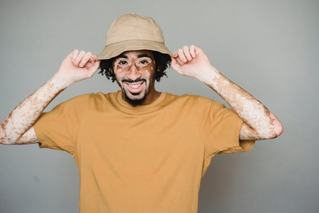 Psoriasis
