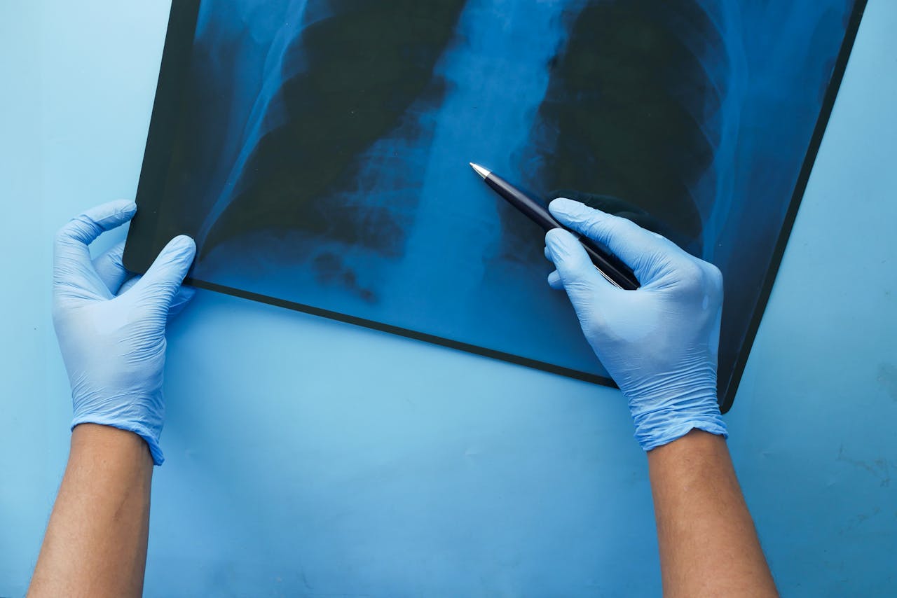 AI lung scans